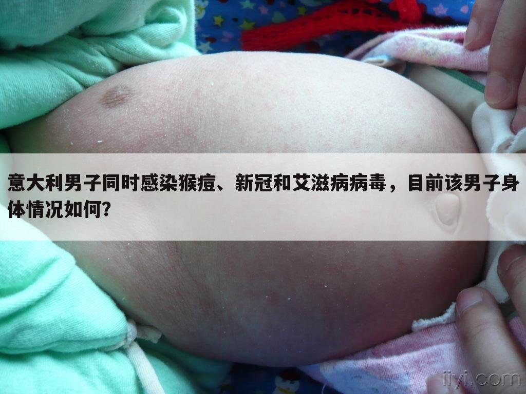 意大利男子同时感染猴痘、新冠和艾滋病病毒,目前该男子身体情况如何?